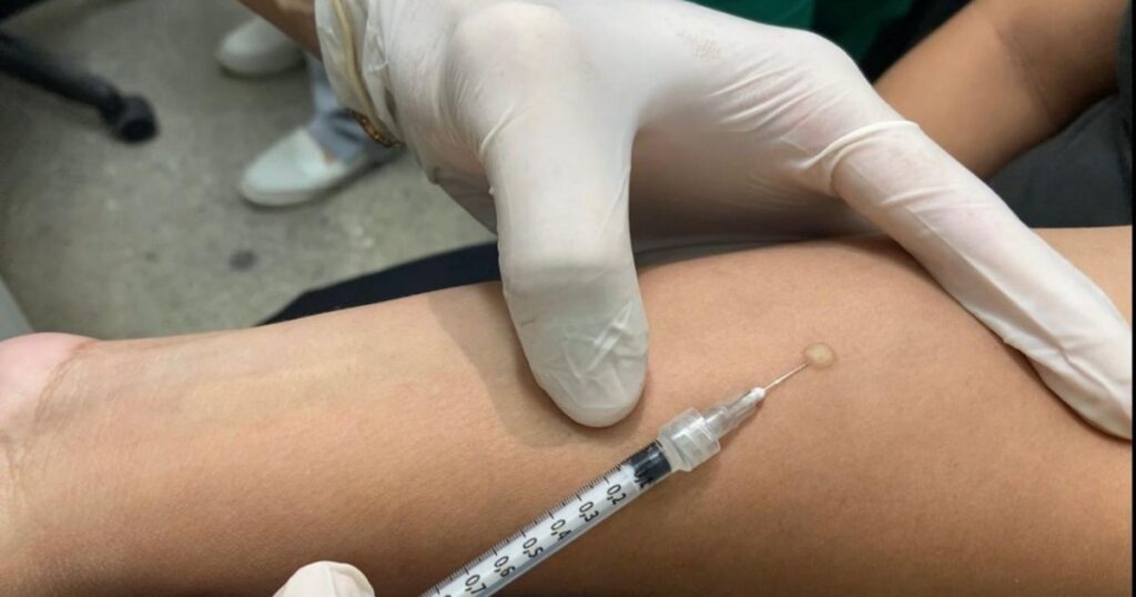 Tratamento preventivo da tuberculose é indicado após avaliação de infecção latente em Manaus